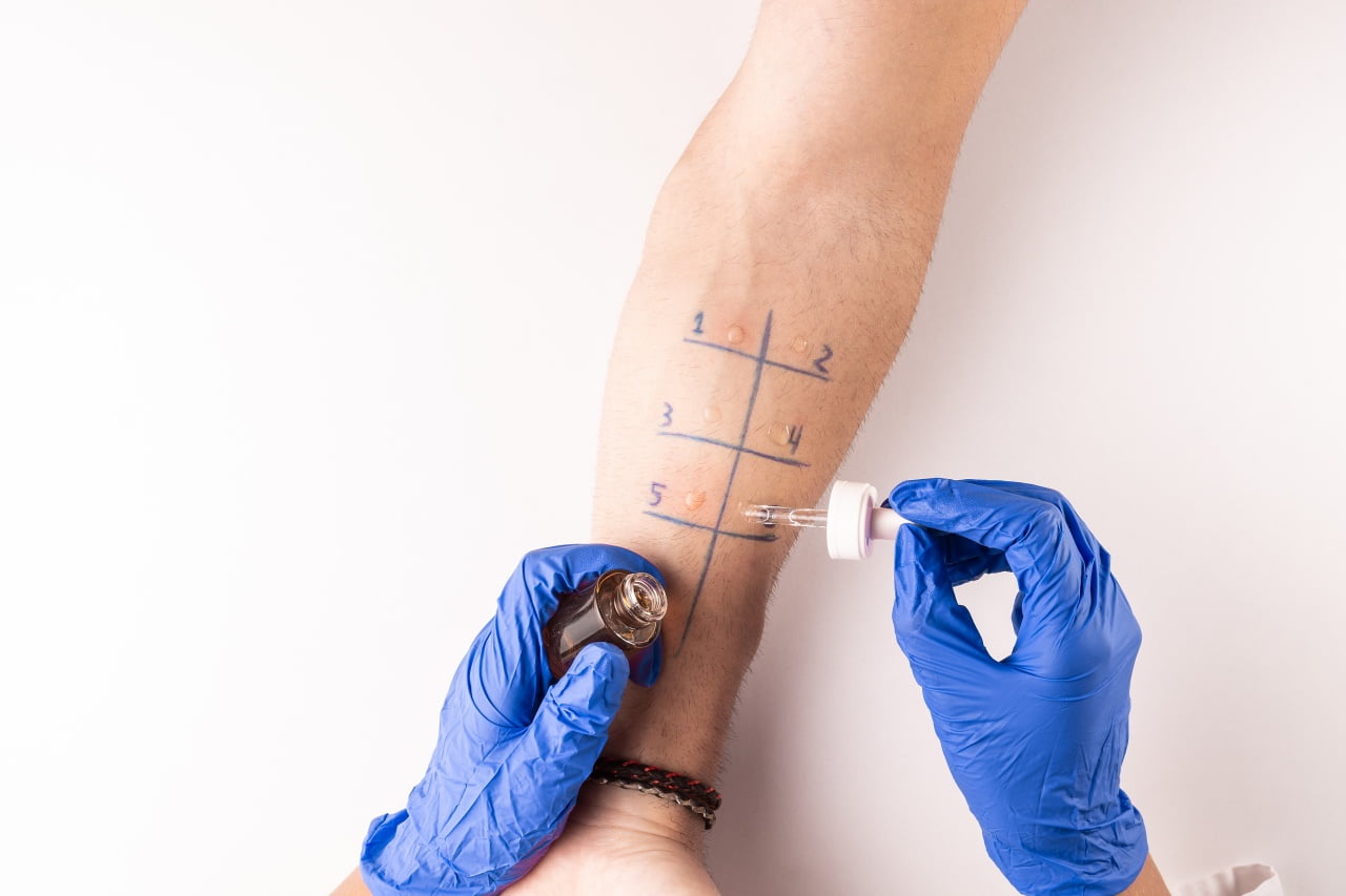 Diagnostyka alergii – jakie testy wykonać?